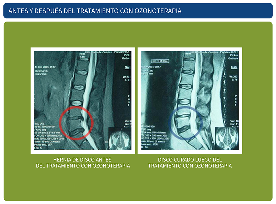 Antes del tratamiento de ozonoterapia