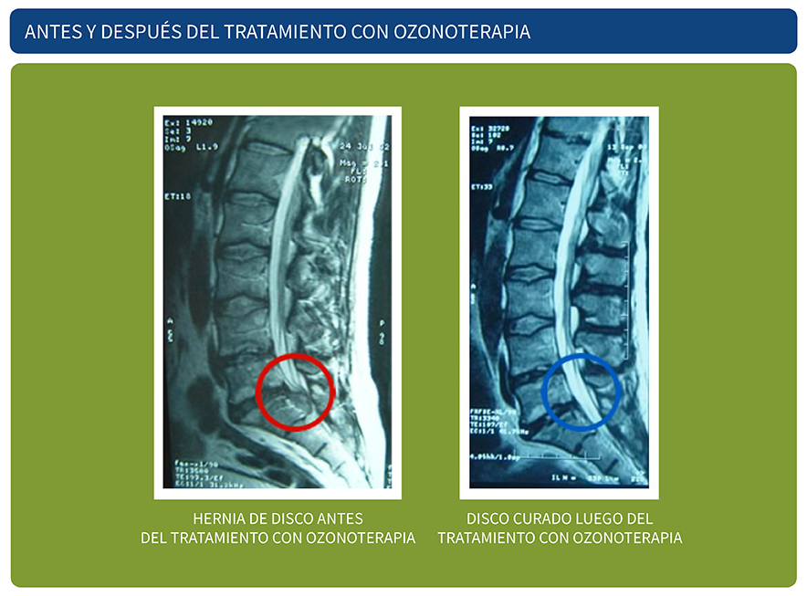 Despues del tratamiento de ozonoterapia